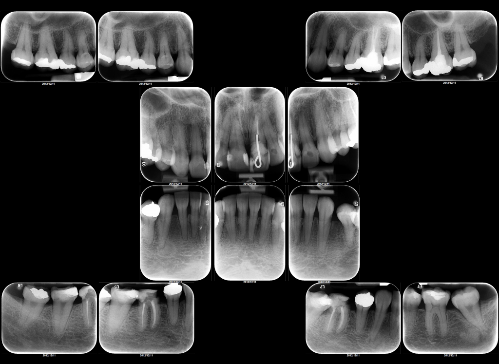 Radiografía Periapical Completa