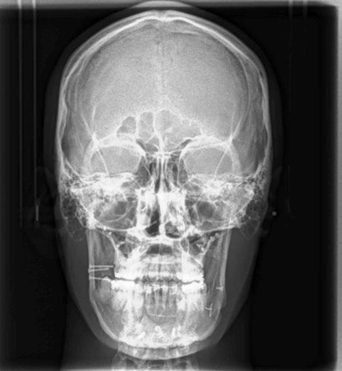 Radiografía Posteroanterior - Anteroposterior