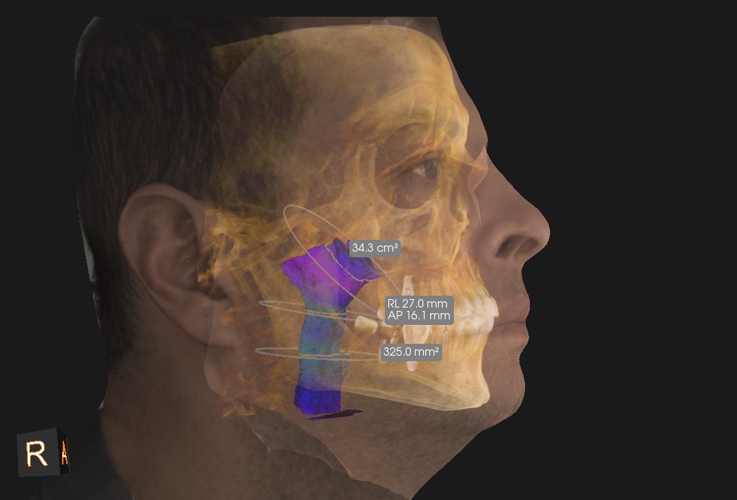 Tomografía Facial con Facescam y vías aéreas