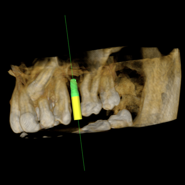 Tomografía de Implante Dental